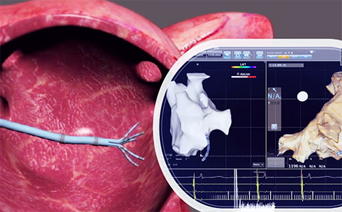 心脏房颤手术3D动画演示